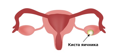 Что такое киста яичника: симптомы и лечение у женщин