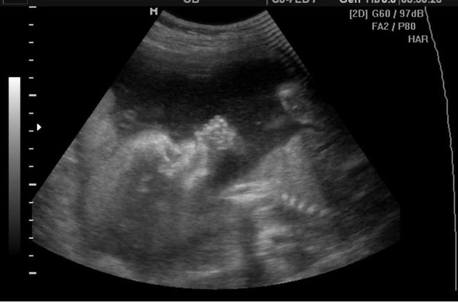 Снимок УЗИ на 22 неделе беременности