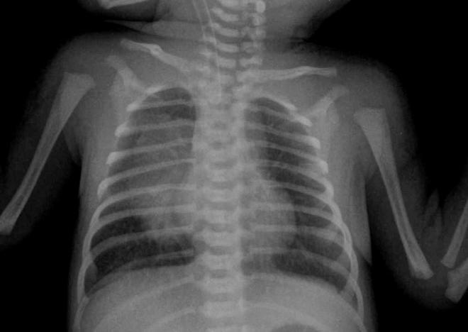 Рентгеновский снимок здоровых лёгких
