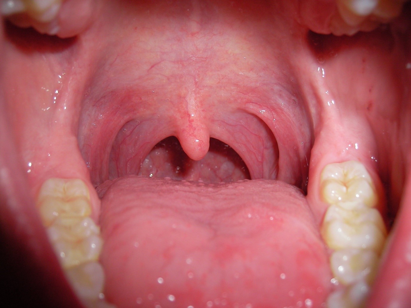 Воспаление горла бывает катаральным, когда в миндалинах нет гнойных пробок, как на этом фото