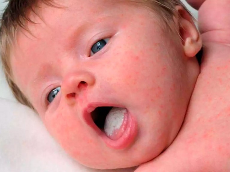У младенцев с дисбактериозом или грибковыми инфекциями могут развиться тяжелые осложнения при острой вирусной или бактериальной инфекции