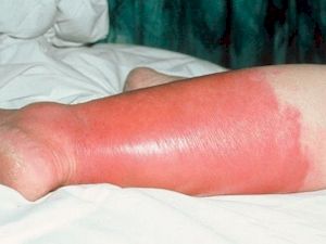 Покраснение кожи на ноге и зуд: основные причины