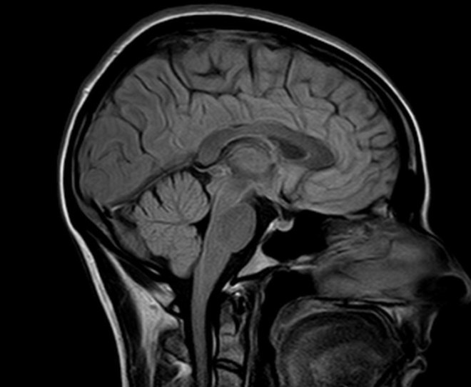 Результат МРТ головного мозга