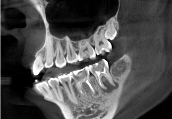 Снимок МРТ зубов