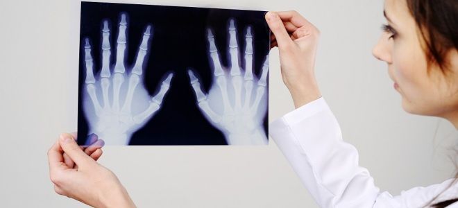 Показания к рентгену руки и особенности выполнения процедуры