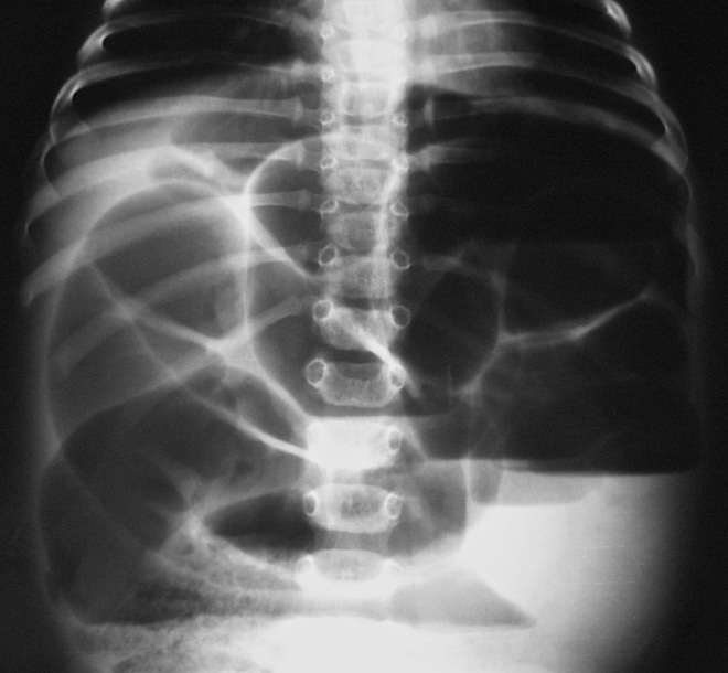 Рентгеновский снимок брюшной полости
