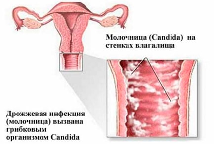 Кандидоз у женщин: симптомы, причины и лечение
