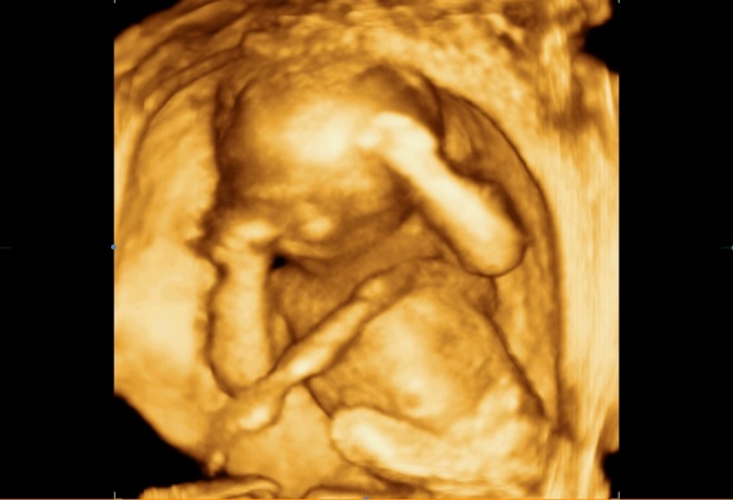 Положение плода на снимке 3Д УЗИ при беременности