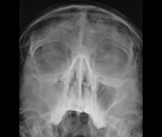 Как видно из рентгенограммы, синусы в толще лобной кости не определяются.