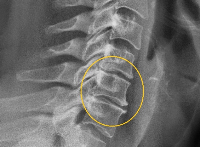 Признаки остеохондроза на рентгене