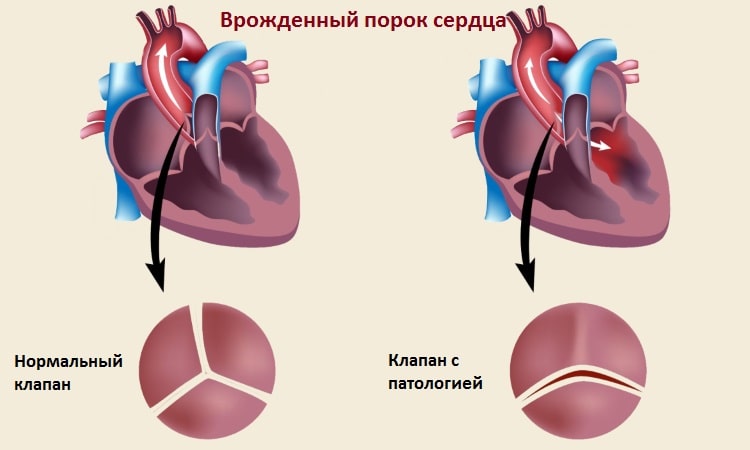 Что покажет МРТ сердца и сосудов