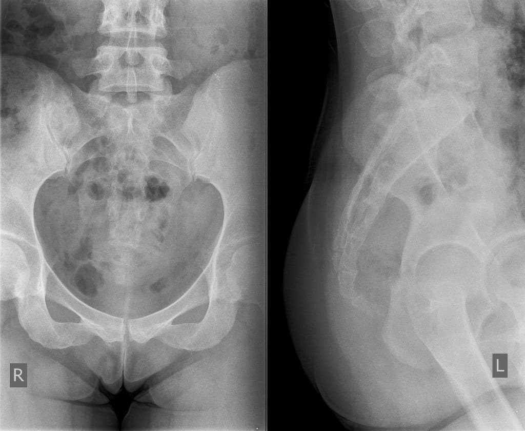 Рентген копчика: особенности проведения диагностики