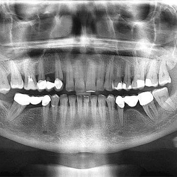 Рентген зубов: когда и зачем делают
