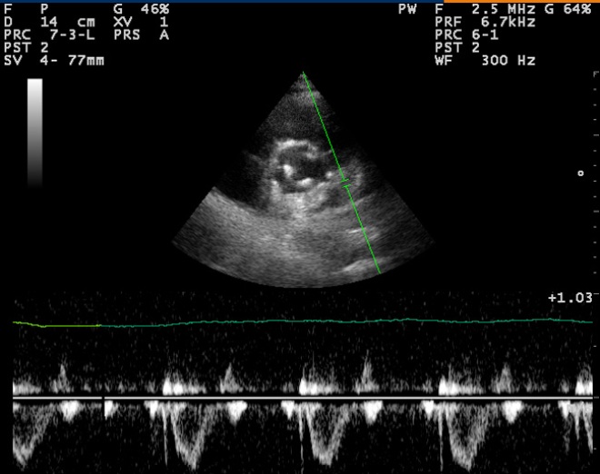Снимок УЗИ сердца при инфаркте миокарда