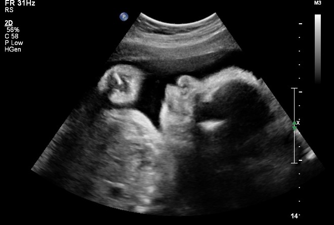Результат УЗИ в 33 недели беременности