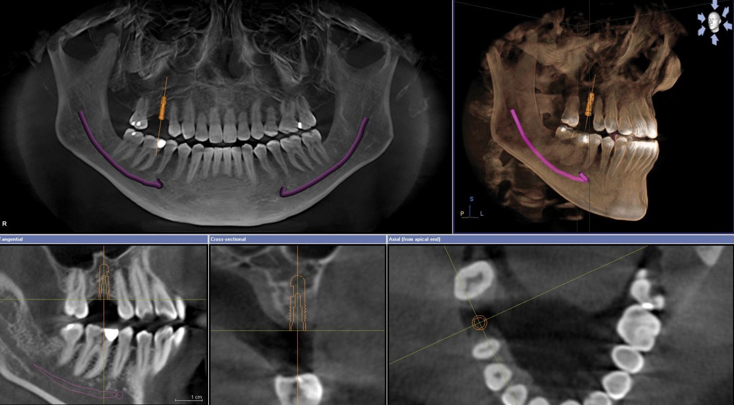 3D-рентген (компьютерная томография) зубов