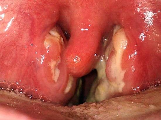 Лакунарная ангина при осмотре горла
