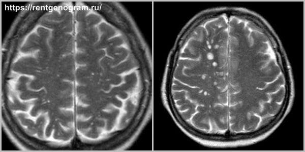 При каких заболеваниях в головном мозге очаги на МРТ