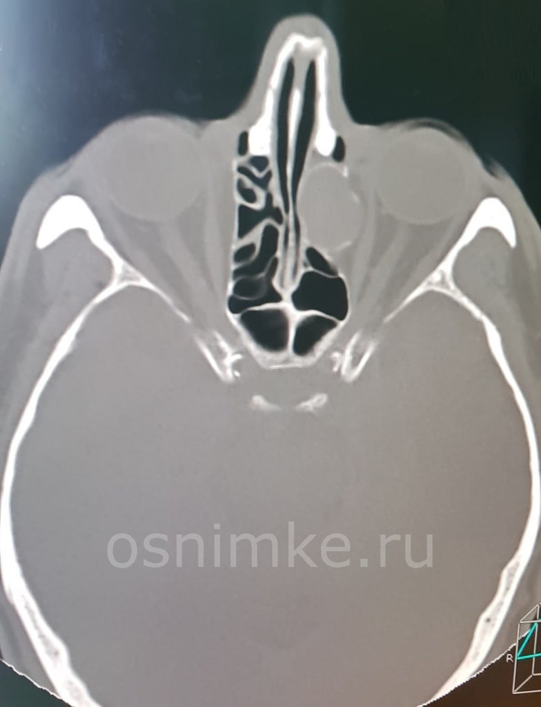 Рентгеновская компьютерная томография в диагностике заболеваний околоносовых синусов