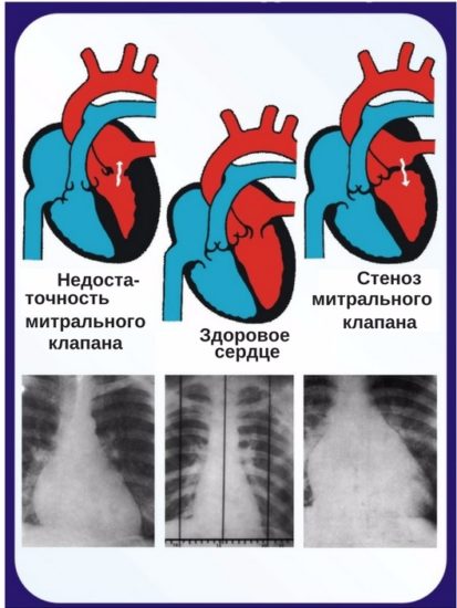Рентгенограмма сердца: снимки с патологиями
