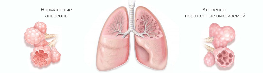 КТ и МРТ лёгких: какое обследование лучше