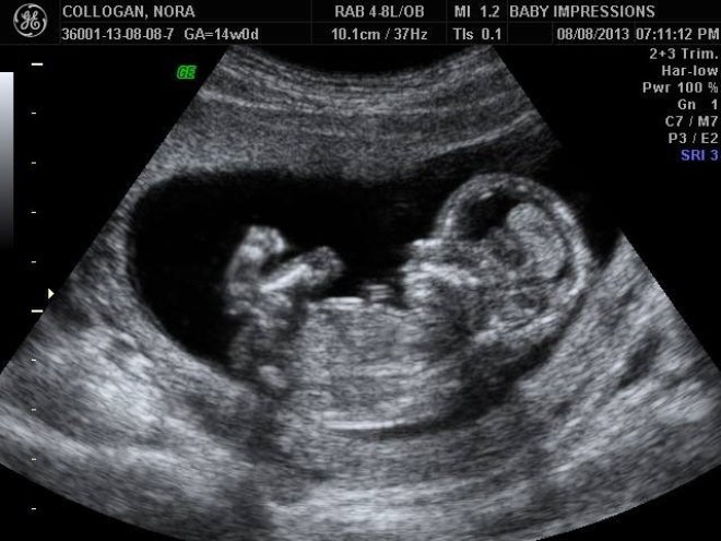 УЗИ снимок на 13 неделе беременности