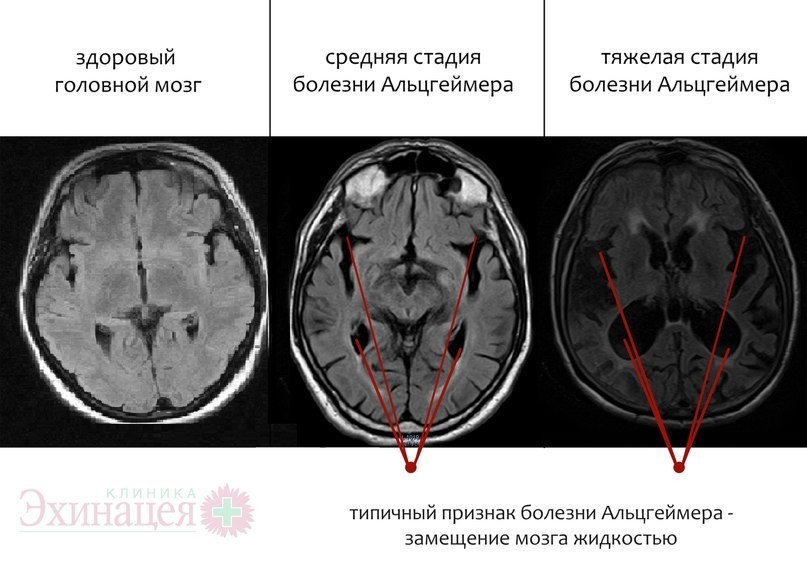 При каких заболеваниях в головном мозге очаги на МРТ