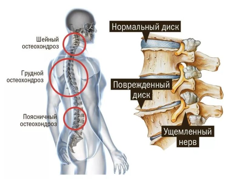 Как делают магнитно-резонансную томографию спины