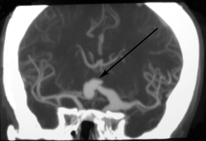 Аневризма на снимке МРТ мозга