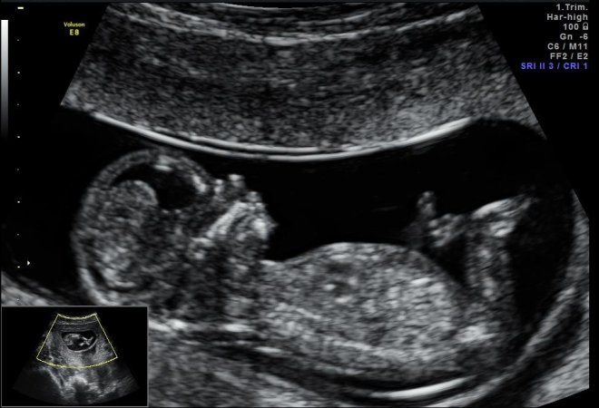 Снимок УЗИ на 3 триместре беременности