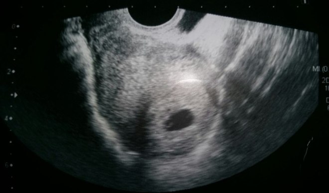 Снимок УЗИ эмбриона