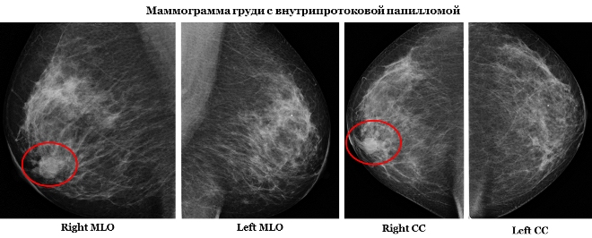 Внутрипротоковая папиллома на маммографическом снимке