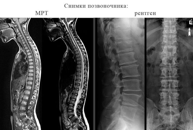 Сравнение снимков позвоночника при рентгене и МРТ
