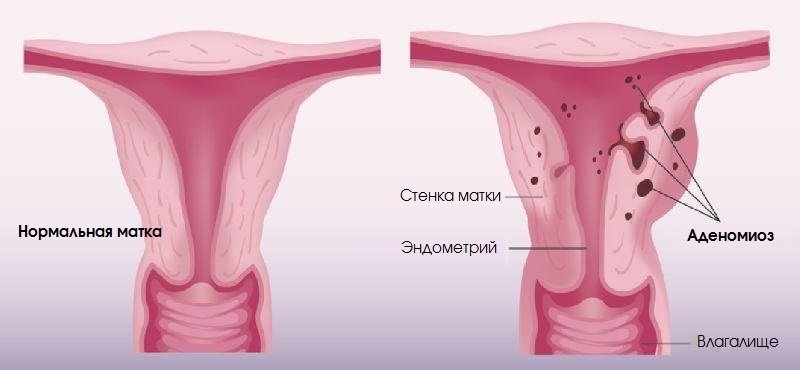 Магнитно-резонансная томография матки и яичников: показания