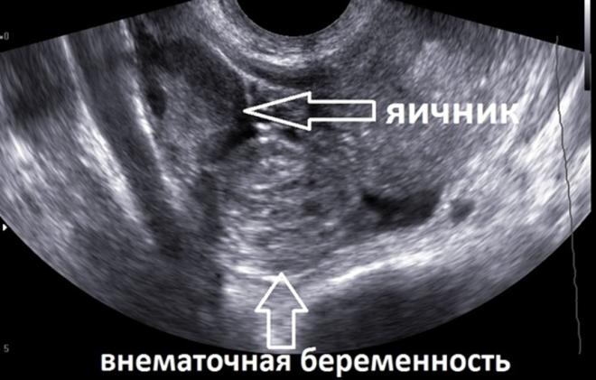 Снимок УЗИ внематочной беременности