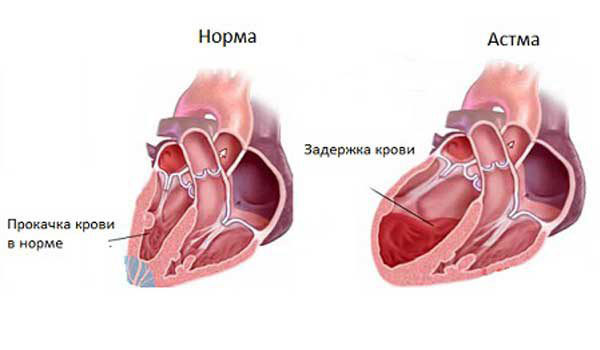 Сердечная астма симптомы и лечение у взрослых