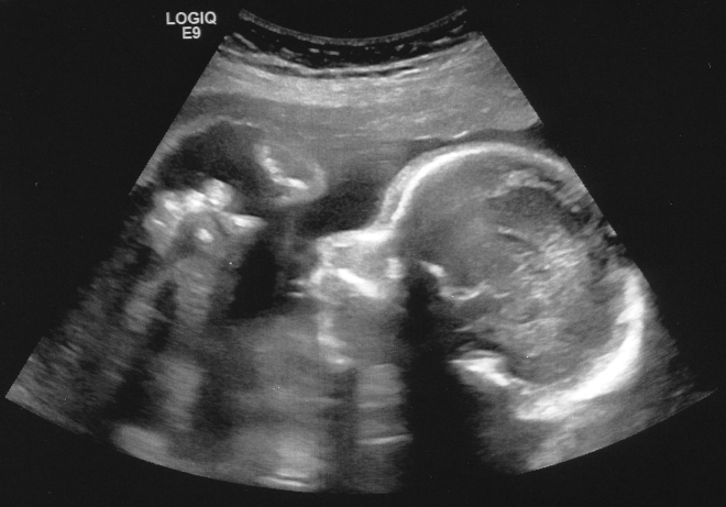 Снимок УЗИ на 27 неделе беременности