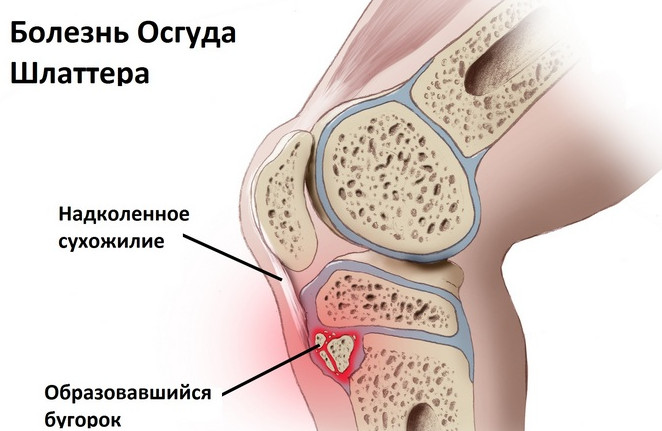 Рентген коленного сустава: что показывает диагностика