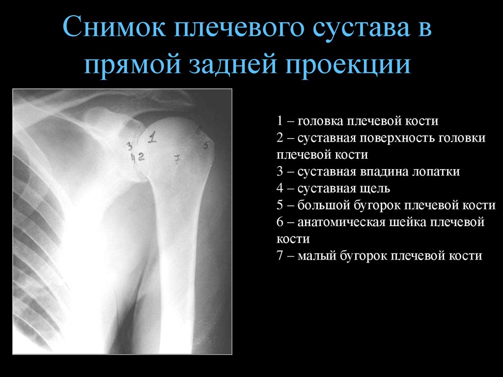 Патологии плечевого сустава: снимок