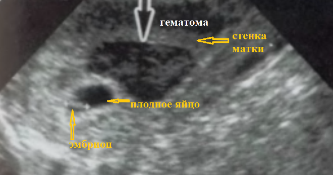 Ретрохориальная гематома на снимке УЗИ