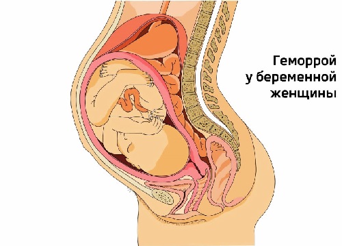 Геморрой при беременности 3 триместр