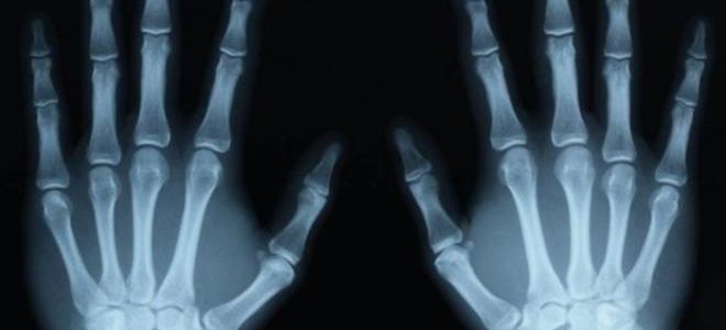Что такое рентгеновское излучение и как оно используется в медицине