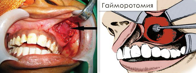 Одонтогенный гайморит опасное последствие кариеса зубов