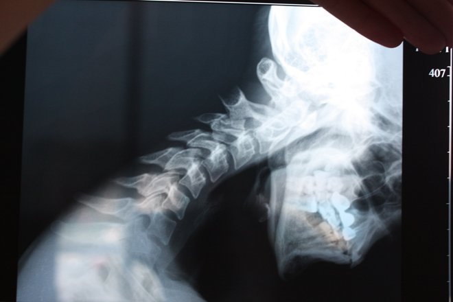 Рентген позвоночника при сгибании шеи