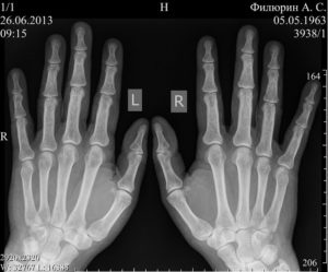 Рентген кисти руки: снимки