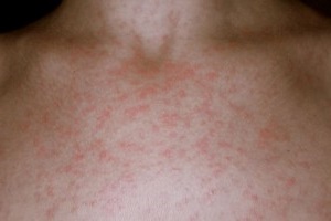 Аллергия на солнце: симптомы (фото), лечение и профилактика