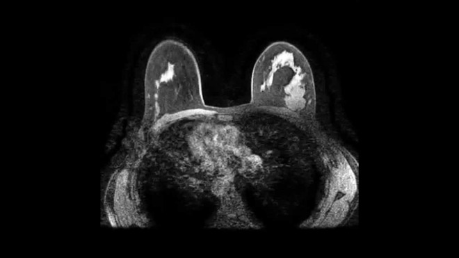 Снимок МРТ молочной железы