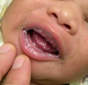 Острые процессы у детей, спровоцированные грибковой инфекцией часто проявляются стоматитом