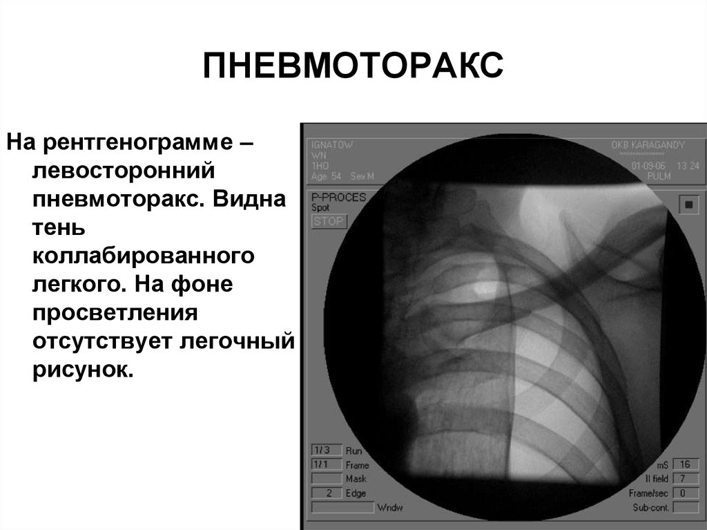 Пневмоторакс: особенности патогенетического характера на рентгене
