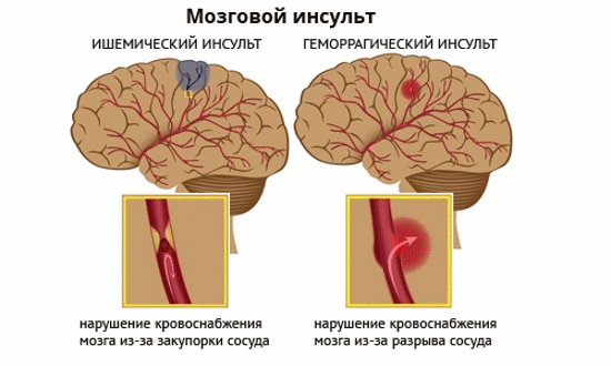 КТ и МРТ головного мозга: отличия методик
